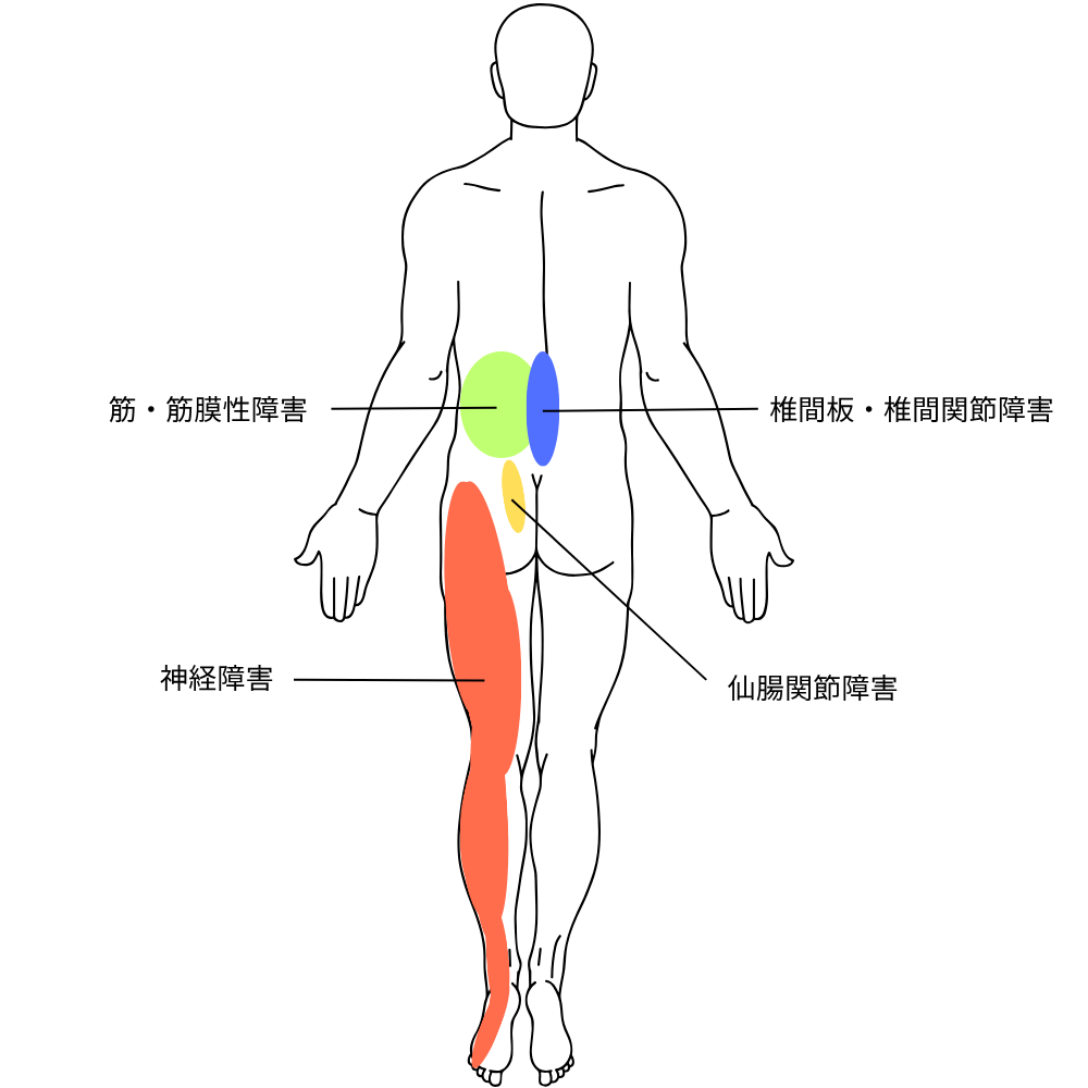 腰痛ボディチャート